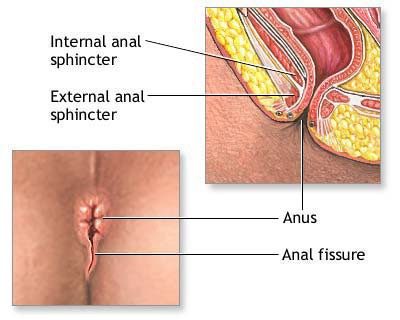 Sphincterotomy